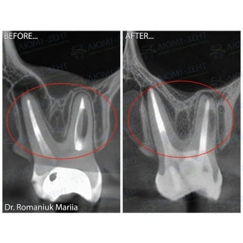 Before and After Treatment of Apical Periodontitis of Tooth 2.7
