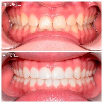 виправлення прикусу зубів