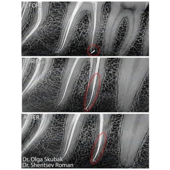 Result of Root Canal Retreatment of Tooth 4.6