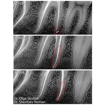 Result of Root Canal Retreatment of Tooth 4.6