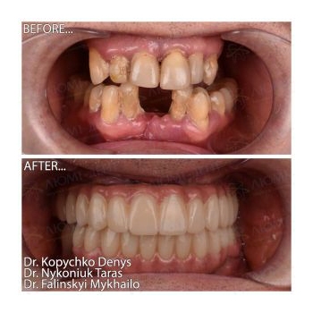 Zirconia dentures on titanium bars All-on-4 Neobiotech