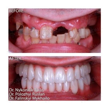 Straumann implants on both jaws using the All-on-6 protocol