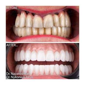 full dental implantation