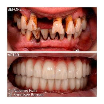 dental implants and prosthetics before and after photos Lumident