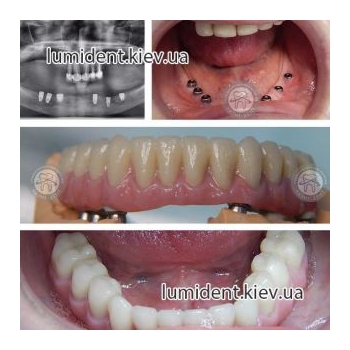 teeth implantation