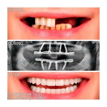 All-on-4 Implantation and Zirconia Prosthetic Rehabilitation with Neodent Implants