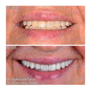 All-on-6 implantation photos by Lumident