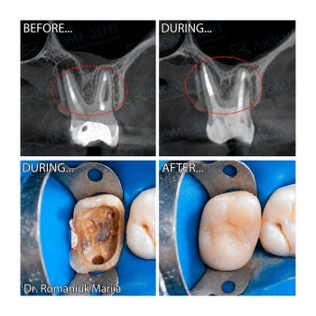 Before and After Treatment of Apical Periodontitis of Tooth 2.7