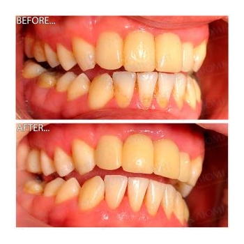 чистка зубів київ