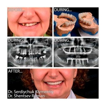 Neodent All-on-6 Implant Treatment