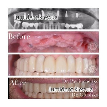 Імплантація зубів Київ фото картинки