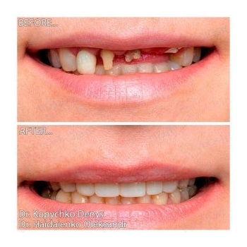 Straumann dental implantation and zirconia crowns