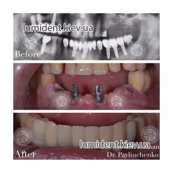 teeth implantation