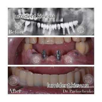 імплантація зубів київ