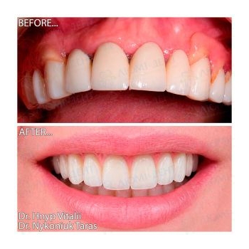 Upper jaw restoration with Straumann implants