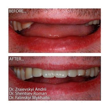Restoration of anterior teeth with Straumann implants