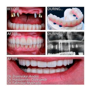 Upper jaw prosthetics on MegaGen AnyRidge All-on-6 implants
