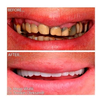 Result of All-on-6 implantation and prosthetic rehabilitation in both jaws