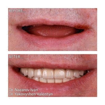dental implants before and after