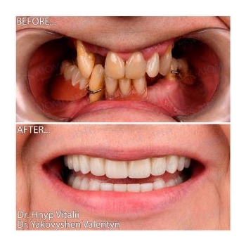Dental implants before and after photos of Lumident implants 