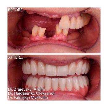 Full rehabilitation of both jaws with Straumann implants