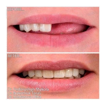 Fixed zirconia prosthetics on All-on-6 implants