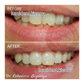 реставрация зубов киев, фото, до и после