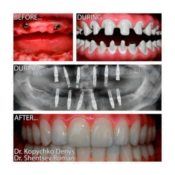 implantation according to the All-on-6 protocol