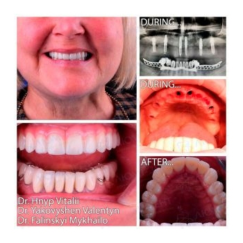 Straumann All-on-6 Upper Jaw Rehabilitation