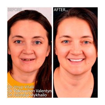Before and after Straumann All-on-4 implantation