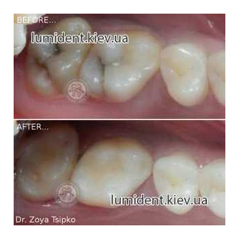 реставрация зубов киев, фото, до и после