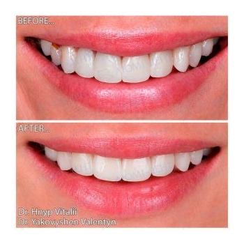 Before and After Full-Mouth Rehabilitation with All-on-4 Implant-Supported Zirconia Restorations