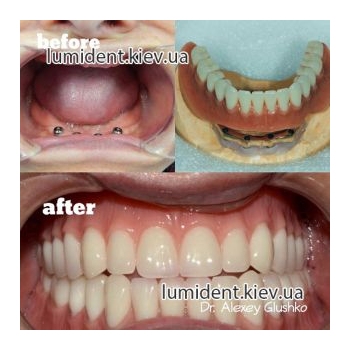 teeth implantation