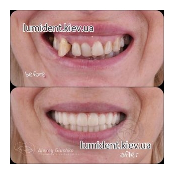зубна імплантація фото люмідент