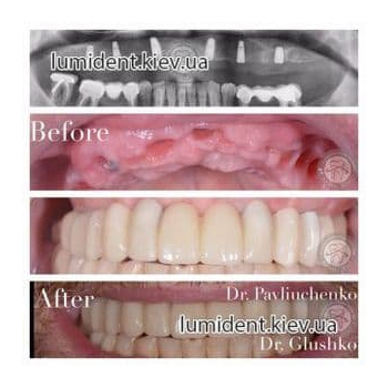 Імплантація зубів Київ фото ціна