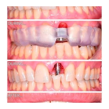 Before and after Straumann implant placement at tooth