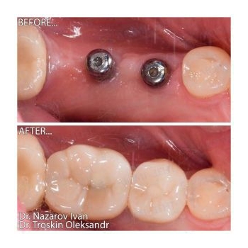 Zirconia crowns on MegaGen AnyRidge implants