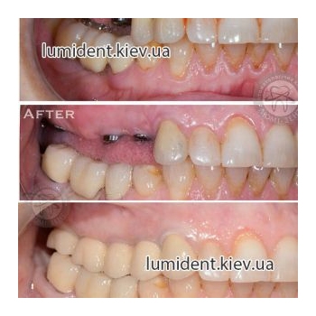Имплантация зубов импланты фото до и после Киев Люми-Дент 