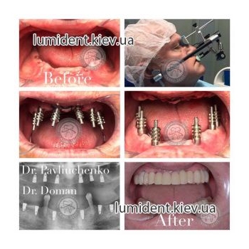 teeth implantation