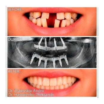 Straumann implants according to All-on-4 protocols