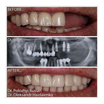 Turnkey dental implantation photos by Lumident