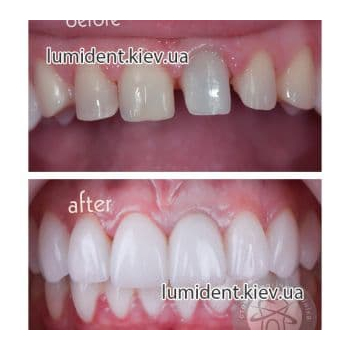 зубное протезирование фото Люмидент