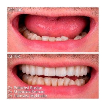 Before and after MegaGen smile restoration