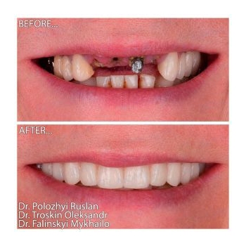 Restoration of anterior teeth on Neodent implants