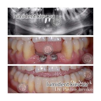 імплантація зубів київ, фото, до і після
