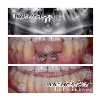 teeth implantation