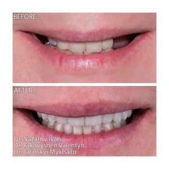 Straumann Implantation and Full-Mouth Rehabilitation