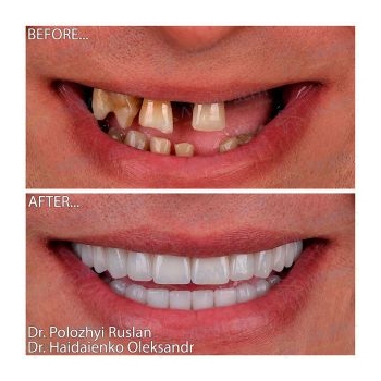 dental implants Kyiv, before and after photo