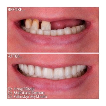 Total rehabilitation with Neobiotech All-on-4 implants