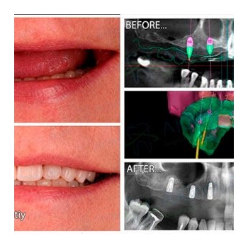 Upper jaw prosthetics using the All-on-6 Neobiotech method